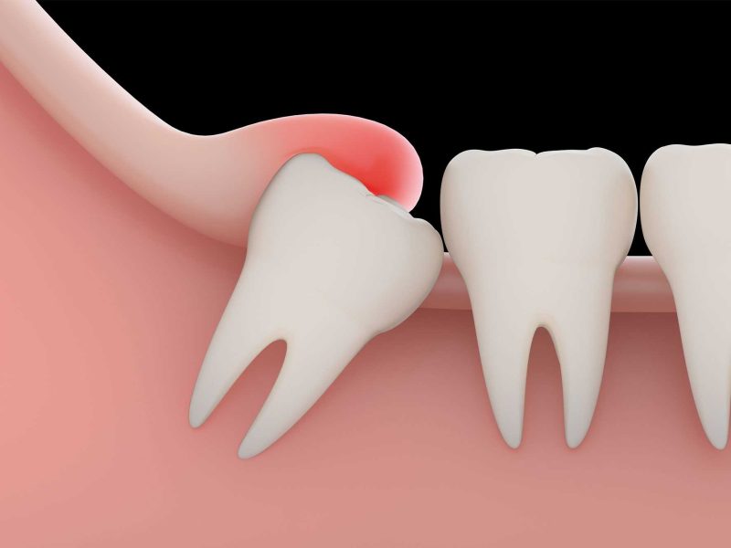 Impacted-Wisdom-Teeth-Removal Impacted-Wisdom-Teeth-Removal