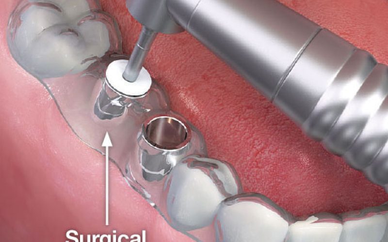 dental-implant dental-implant