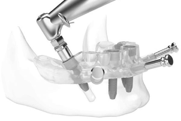digital implant