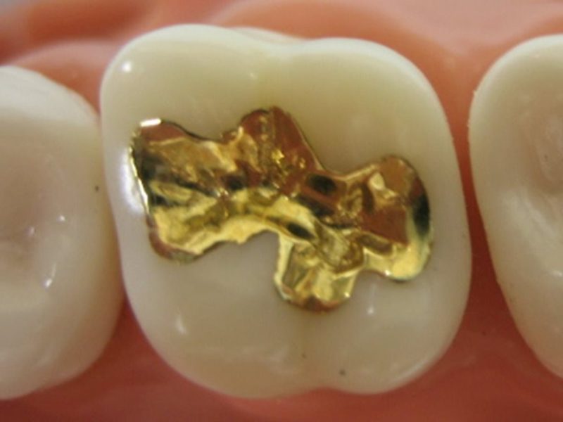 inlay inlay